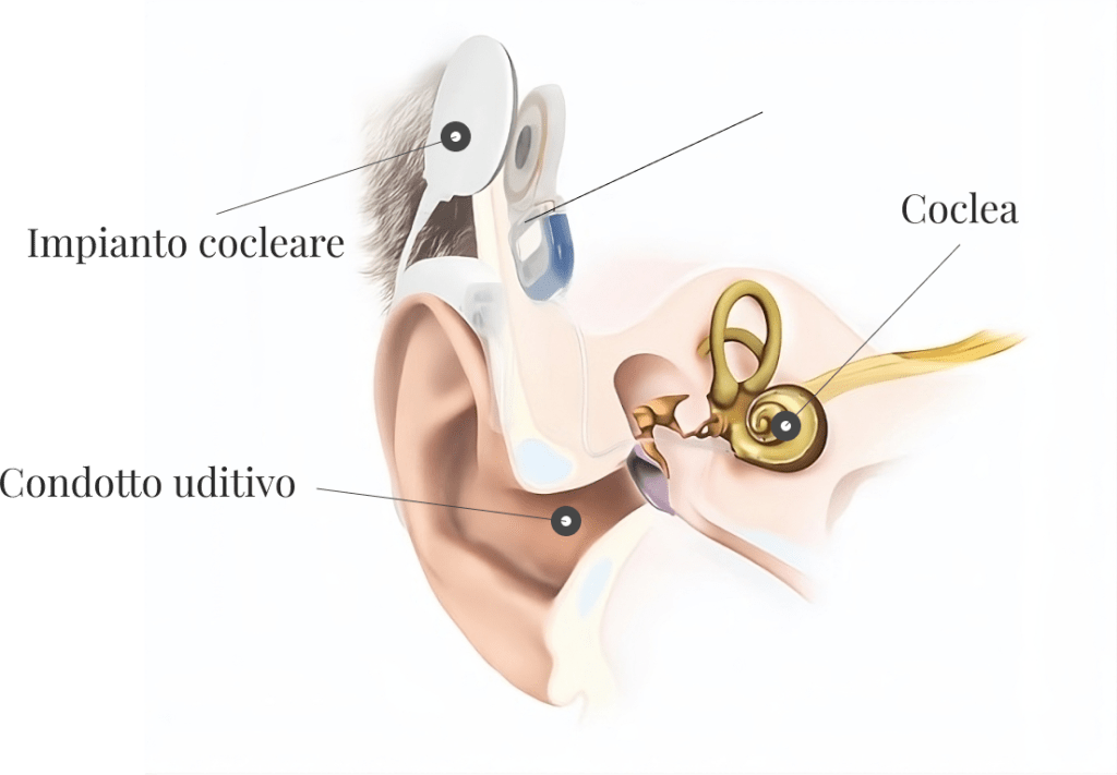 cochlear-img